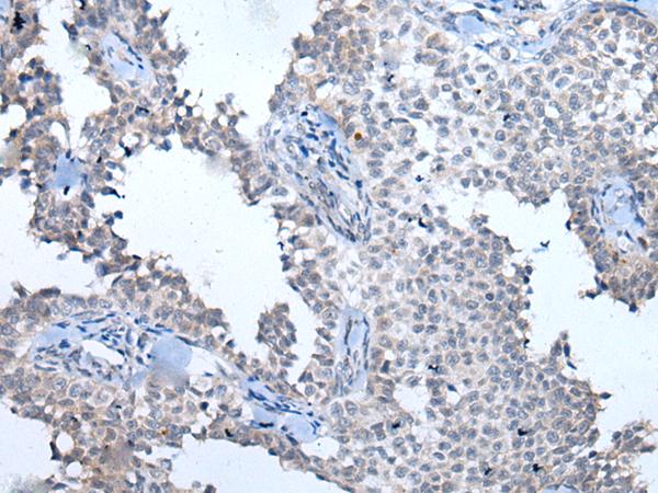 ATM Antibody - Immunohistochemistry of paraffin-embedded Human ovarian cancer tissue  using ATM Polyclonal Antibody at dilution of 1:65(×200)