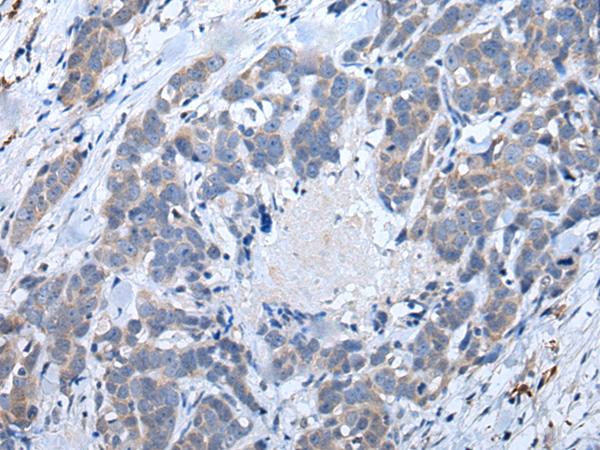 ATM Antibody - Immunohistochemistry of paraffin-embedded Human thyroid cancer tissue  using ATM Polyclonal Antibody at dilution of 1:65(×200)