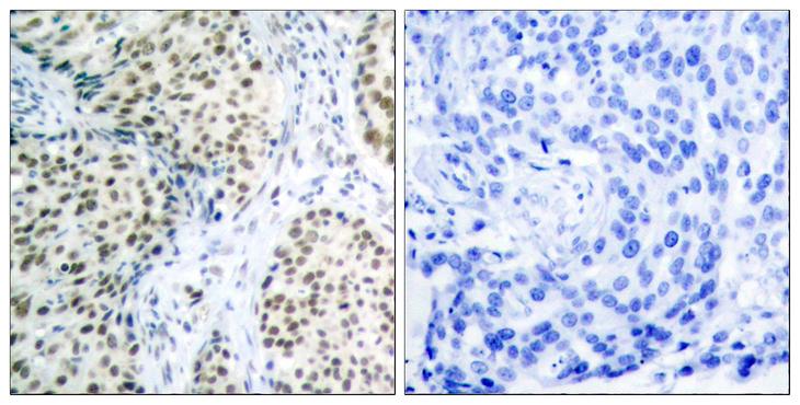 ATM Antibody - Peptide - + Immunohistochemical analysis of paraffin-embedded human breast carcinoma tissue using ATM (Ab-1981) antibody.