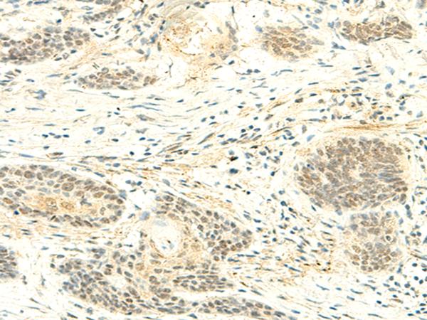 ATMIN Antibody - Immunohistochemistry of paraffin-embedded Human esophagus cancer tissue  using ATMIN Polyclonal Antibody at dilution of 1:50(×200)
