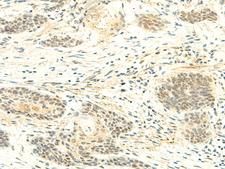 ATMIN Antibody - Immunohistochemistry of paraffin-embedded Human esophagus cancer tissue  using ATMIN Polyclonal Antibody at dilution of 1:50(×200)