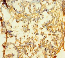 ATOH1 / MATH-1 Antibody - Immunohistochemistry of paraffin-embedded human breast cancer using ATOH1 Antibody at dilution of 1:100