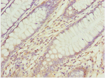 ATOH7 / MATH5 Antibody - Immunohistochemistry of paraffin-embedded human colon cancer at dilution 1:100