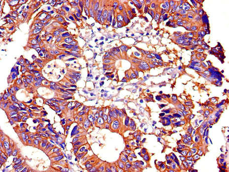 ATP1A1 Antibody - Immunohistochemistry of paraffin-embedded human colon cancer using ATP1A1 Antibody at dilution of 1:100