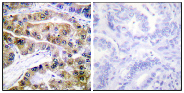 ATP1A1 Antibody - Immunohistochemistry analysis of paraffin-embedded human lung carcinoma, using ATPase (Phospho-Ser16) Antibody. The picture on the right is blocked with the phospho peptide.