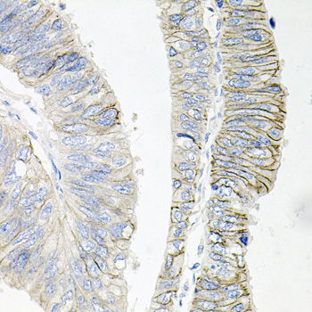 ATP1B1 Antibody - Immunohistochemistry of paraffin-embedded human colon carcinoma tissue.