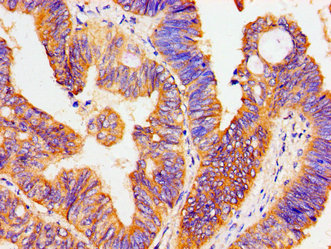 ATP1B1 Antibody - Immunohistochemistry image of paraffin-embedded human colon cancer at a dilution of 1:100