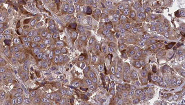 ATP1B1 Antibody - 1:100 staining human liver carcinoma tissues by IHC-P. The sample was formaldehyde fixed and a heat mediated antigen retrieval step in citrate buffer was performed. The sample was then blocked and incubated with the antibody for 1.5 hours at 22°C. An HRP conjugated goat anti-rabbit antibody was used as the secondary.