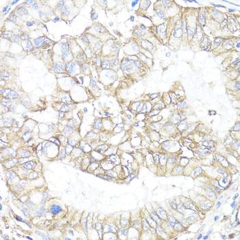 ATP1B1 Antibody - Immunohistochemistry of paraffin-embedded Human lung cancer using ATP1B1 Polyclonal Antibody at dilution of 1:100 (40x lens).