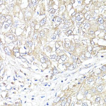 ATP1B1 Antibody - Immunohistochemistry of paraffin-embedded Human liver cancer using ATP1B1 Polyclonal Antibody at dilution of 1:100 (40x lens).