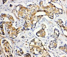 ATP2A2 / SERCA2 Antibody - ATP2A2 / SERCA2 antibody. IHC(P): Human Breast Cancer Tissue.