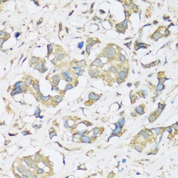 ATP2A3 / SERCA3 Antibody - Immunohistochemistry of paraffin-embedded Human breast cancer using ATP2A3 Polyclonal Antibody at dilution of 1:100 (40x lens).