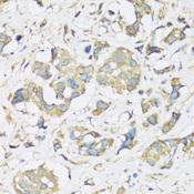 ATP2A3 / SERCA3 Antibody - Immunohistochemistry of paraffin-embedded Human breast cancer using ATP2A3 Polyclonal Antibody at dilution of 1:100 (40x lens).