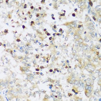 ATP2A3 / SERCA3 Antibody - Immunohistochemistry of paraffin-embedded Human uterine cancer using ATP2A3 Polyclonal Antibody at dilution of 1:100 (40x lens).