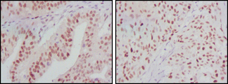 ATP2C1 Antibody - IHC of paraffin-embedded human ovarian cancer (left) and breast cancer (right) tissues using ATP2C1 mouse monoclonal antibody with DAB staining.