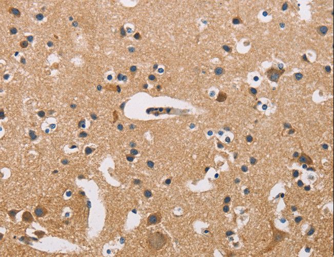 ATP2C1 Antibody - Immunohistochemistry of paraffin-embedded Human prostate cancer using ATP2C1 Polyclonal Antibody at dilution of 1:50.