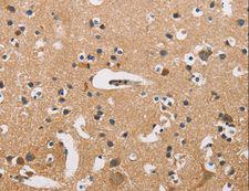 ATP2C1 Antibody - Immunohistochemistry of paraffin-embedded Human prostate cancer using ATP2C1 Polyclonal Antibody at dilution of 1:50.