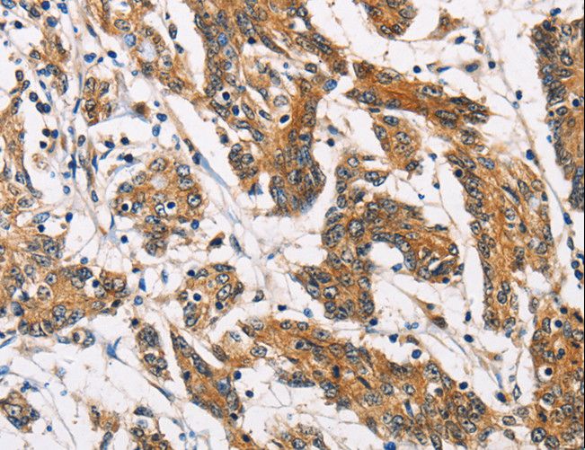 ATP2C1 Antibody - Immunohistochemistry of paraffin-embedded Human colon cancer using ATP2C1 Polyclonal Antibody at dilution of 1:60.
