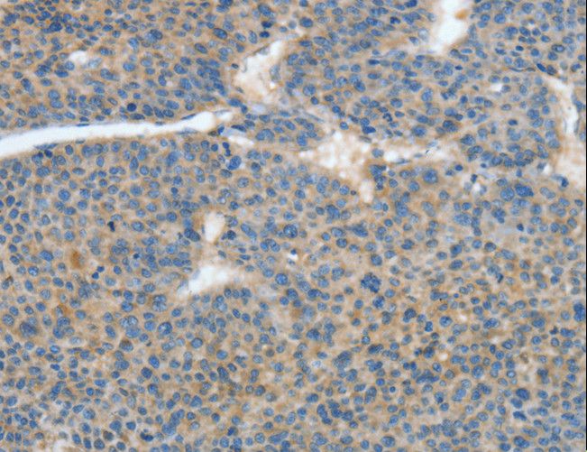 ATP4B Antibody - Immunohistochemistry of paraffin-embedded Human thyroid cancer using ATP4B Polyclonal Antibody at dilution of 1:40.