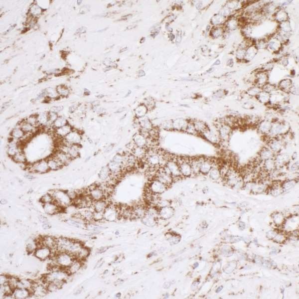 ATP5A1 / ATP Synthase Alpha Antibody - Detection of human ATP5A1 by immunohistochemistry. Sample: FFPE section of human prostate carcinoma. Antibody: Affinity purified rabbit anti-ATP5A1 used at a dilution of 1:5,000 (0.2µg/ml). Detection: DAB