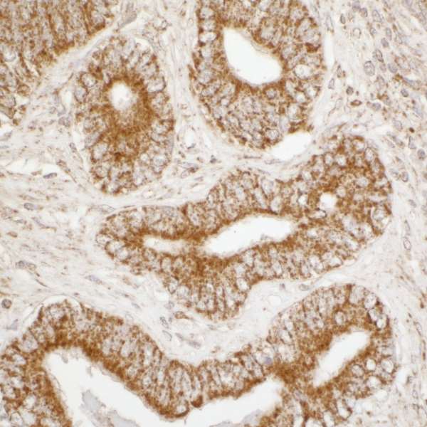 ATP5A1 / ATP Synthase Alpha Antibody - Detection of human ATP5A1 by immunohistochemistry. Sample: FFPE section of human prostate carcinoma. Antibody: Affinity purified rabbit anti-ATP5A1 used at a dilution of 1:5,000 (0.2µg/ml). Detection: DAB