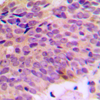 ATP5A1 / ATP Synthase Alpha Antibody - Immunohistochemical analysis of ATP5A1 staining in human breast cancer formalin fixed paraffin embedded tissue section. The section was pre-treated using heat mediated antigen retrieval with sodium citrate buffer (pH 6.0). The section was then incubated with the antibody at room temperature and detected using an HRP conjugated compact polymer system. DAB was used as the chromogen. The section was then counterstained with hematoxylin and mounted with DPX.