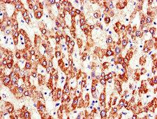 ATP5A1 / ATP Synthase Alpha Antibody - Immunohistochemistry of paraffin-embedded human liver cancer using ATP5F1A Antibody at dilution of 1:100