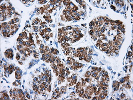 ATP5B / ATP Synthase Beta Antibody - IHC of paraffin-embedded Carcinoma of liver tissue using anti-ATP5B mouse monoclonal antibody. (Dilution 1:50).