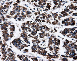 ATP5B / ATP Synthase Beta Antibody - Immunohistochemical staining of paraffin-embedded Carcinoma of liver tissue using anti-ATP5B mouse monoclonal antibody. (Dilution 1:50).
