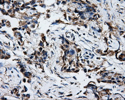 ATP5B / ATP Synthase Beta Antibody - Immunohistochemical staining of paraffin-embedded Adenocarcinoma of breast tissue using anti-ATP5B mouse monoclonal antibody. (Dilution 1:50).