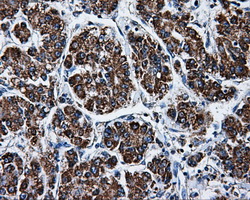 ATP5B / ATP Synthase Beta Antibody - Immunohistochemical staining of paraffin-embedded Carcinoma of liver tissue using anti-ATP5B mouse monoclonal antibody. (Dilution 1:50).
