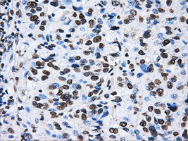 ATP5B / ATP Synthase Beta Antibody - IHC of paraffin-embedded Carcinoma of bladder tissue using anti-ATP5B mouse monoclonal antibody. (Dilution 1:50).
