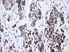 ATP5B / ATP Synthase Beta Antibody - IHC of paraffin-embedded Adenocarcinoma of breast tissue using anti-ATP5B mouse monoclonal antibody. (Dilution 1:50).