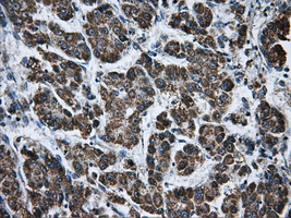 ATP5B / ATP Synthase Beta Antibody - IHC of paraffin-embedded Carcinoma of liver tissue using anti-ATP5B mouse monoclonal antibody. (Dilution 1:50).