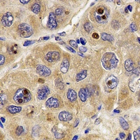 ATP5B / ATP Synthase Beta Antibody - Immunohistochemical analysis of ATP5B staining in human liver cancer formalin fixed paraffin embedded tissue section. The section was pre-treated using heat mediated antigen retrieval with sodium citrate buffer (pH 6.0). The section was then incubated with the antibody at room temperature and detected using an HRP conjugated compact polymer system. DAB was used as the chromogen. The section was then counterstained with hematoxylin and mounted with DPX.