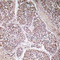 ATP5C1 Antibody - Immunohistochemical analysis of ATP5C1 staining in human liver cancer formalin fixed paraffin embedded tissue section. The section was pre-treated using heat mediated antigen retrieval with sodium citrate buffer (pH 6.0). The section was then incubated with the antibody at room temperature and detected with HRP and DAB as chromogen. The section was then counterstained with hematoxylin and mounted with DPX.