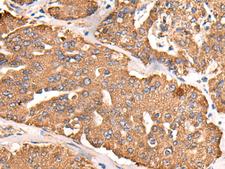 ATP5C1 Antibody - Immunohistochemistry of paraffin-embedded Human liver cancer tissue  using ATP5C1 Polyclonal Antibody at dilution of 1:55(×200)