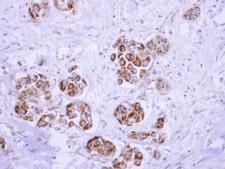 ATP5D Antibody - ATP synthase delta antibody detects ATP5D protein at mitochondria on breast carcinoma by immunohistochemical analysis. Sample: Paraffin-embedded breast carcinoma. ATP synthase delta antibody dilution:1:250.