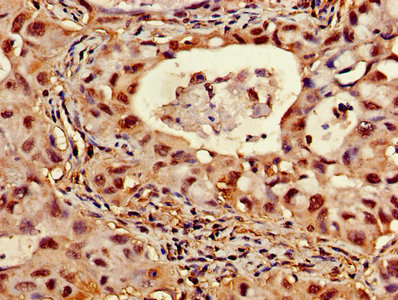 ATP5D Antibody - Immunohistochemistry of paraffin-embedded human liver cancer using ATP5D Antibody at dilution of 1:100