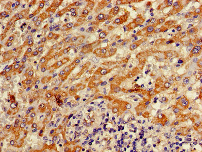 ATP5D Antibody - Immunohistochemistry of paraffin-embedded human lung cancer using ATP5D Antibody at dilution of 1:100