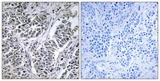 ATP5D Antibody - Peptide - + Immunohistochemistry analysis of paraffin-embedded human lung carcinoma tissue using ATP5D antibody.