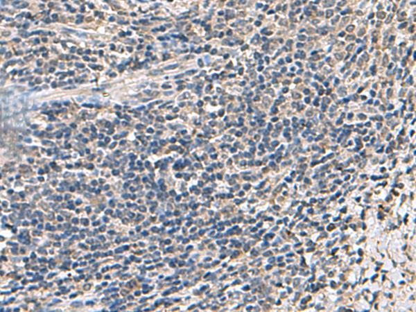 ATP5D Antibody - Immunohistochemistry of paraffin-embedded Human cervical cancer tissue  using ATP5F1D Polyclonal Antibody at dilution of 1:55(×200)