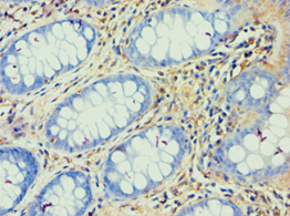 ATP5F1 Antibody - Immunohistochemistry of paraffin-embedded human colon cancer using antibody at 1:100 dilution.