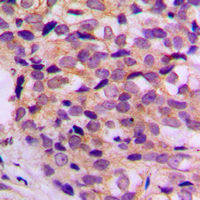ATP5G1 / ATP5G Antibody - Immunohistochemical analysis of ATP5G1 staining in human breast cancer formalin fixed paraffin embedded tissue section. The section was pre-treated using heat mediated antigen retrieval with sodium citrate buffer (pH 6.0). The section was then incubated with the antibody at room temperature and detected using an HRP conjugated compact polymer system. DAB was used as the chromogen. The section was then counterstained with hematoxylin and mounted with DPX. w