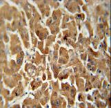 ATP5G2 Antibody - ATP5G2 antibody immunohistochemistry of formalin-fixed and paraffin-embedded human hepatocarcinoma followed by peroxidase-conjugated secondary antibody and DAB staining.