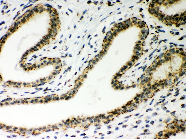 ATP5H Antibody - ATP5H antibody IHC-paraffin: Human Mammary Cancer Tissue.