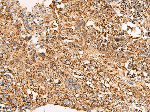 ATP5I Antibody - Immunohistochemistry of paraffin-embedded Human cervical cancer tissue  using ATP5I Polyclonal Antibody at dilution of 1:65(×200)