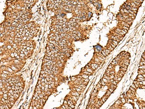 ATP5I Antibody - Immunohistochemistry of paraffin-embedded Human colorectal cancer tissue  using ATP5I Polyclonal Antibody at dilution of 1:65(×200)