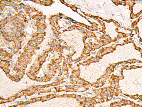 ATP5I Antibody - Immunohistochemistry of paraffin-embedded Human thyroid cancer tissue  using ATP5I Polyclonal Antibody at dilution of 1:30(×200)