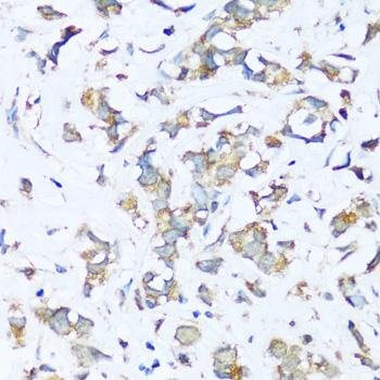 ATP5I Antibody - Immunohistochemistry of paraffin-embedded Human breast cancer using ATP5I Polyclonal Antibody at dilution of 1:100 (40x lens).